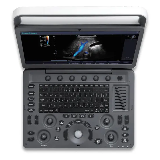 Medical Hospital Equipment Portable Color Doppler Sonoscape E2 Ultrasound Machine