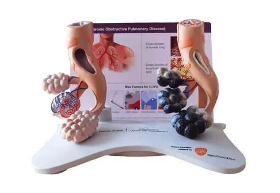 Copd (Chronic Obstructive Pulmonary Disease) Medical Educational Model, Healthy Bronchus & Bronchitis Lung Disease Model for Patient Education