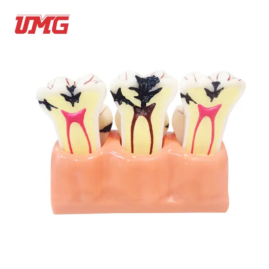Caries Comparation Model Teaching Practice Model