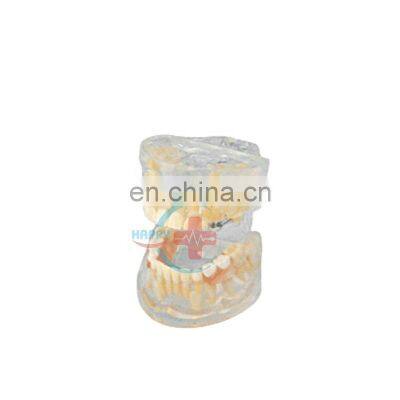 HC-S409 hot sale Human dental study model transparent dental pediatric model pvc baby teeth development model